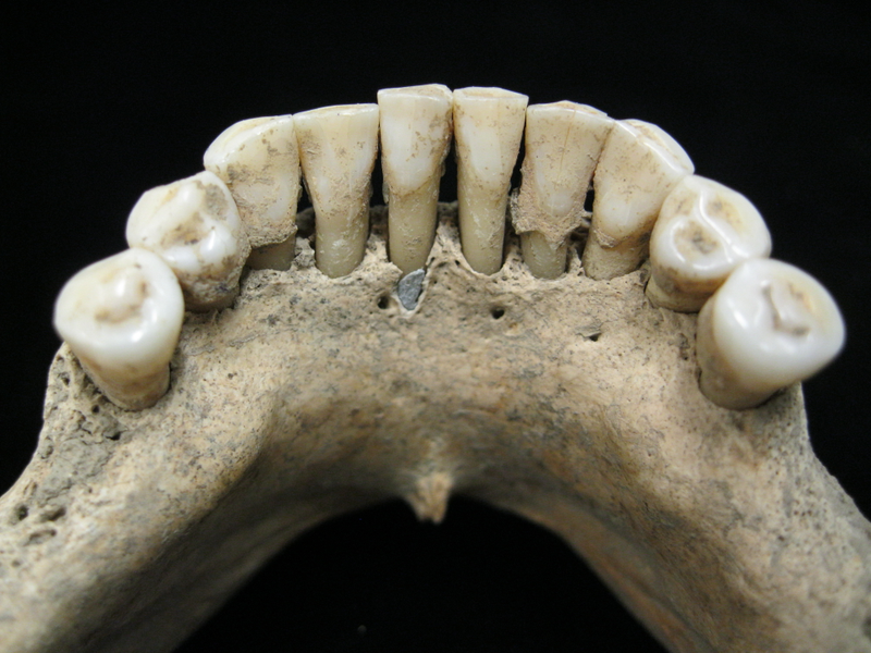 The medieval woman’s teeth.
